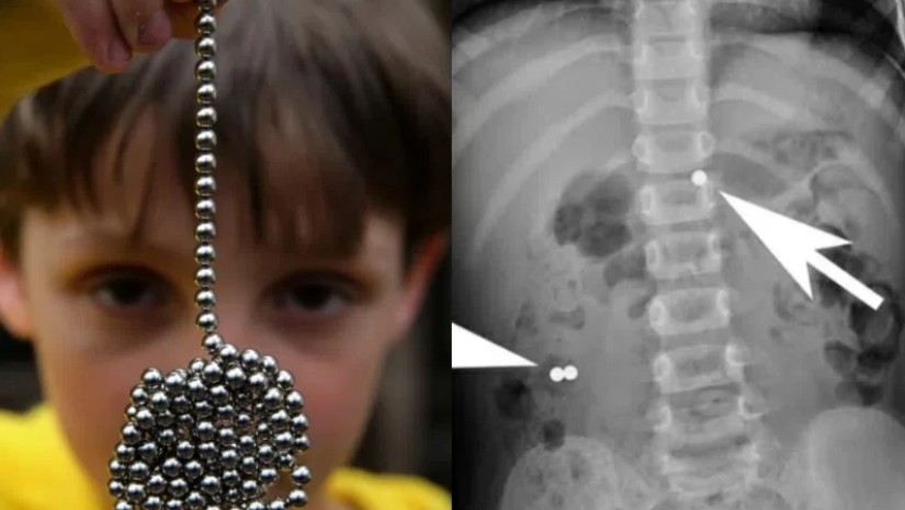 ექიმების საგანგაშო გაფრთხილება – ერთი შეხედვით უწყინარი სათამაშო, რომელმაც შეიძლება ბავშვის სიცოცხლე საფრთხეში ჩააგდოს